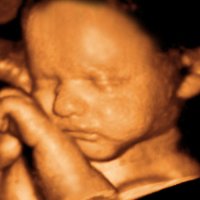 4 Boyutlu Ultrasonografi
